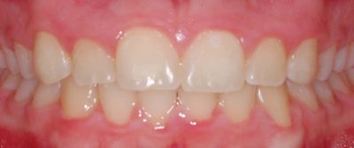 Orthodontics, Braces Crowding After Photo